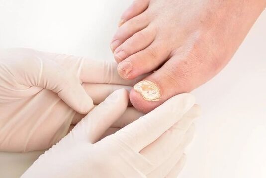 Doctors recommend Fungent for the treatment of athlete's foot