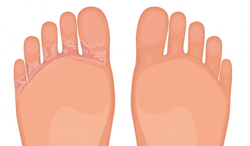 Fungent is effective against all types of athlete's foot