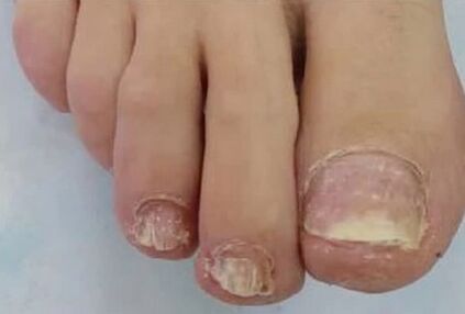 Nails are severely affected by fungus