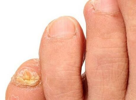 Fungus on the feet