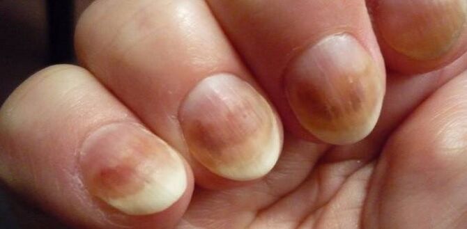 Infection with nail micosis