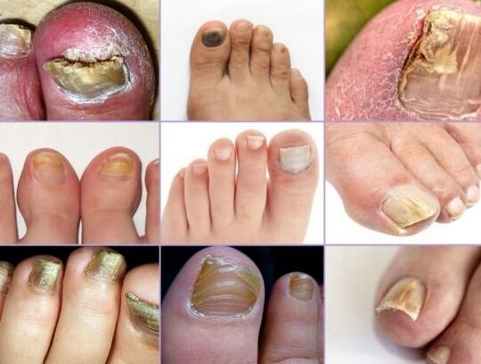 Nail damage to different types of fungus