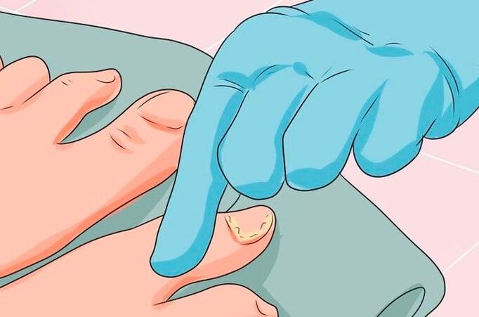 The first sign of mycosis nails