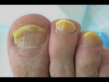 Fungal treatment