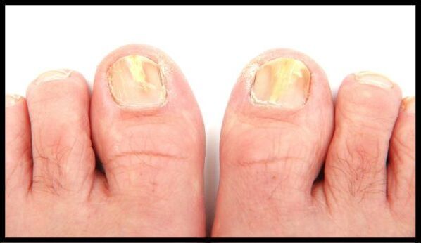 Nail fungus