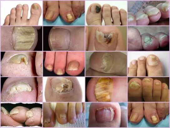 Onychomycosis of various localizations on the nails