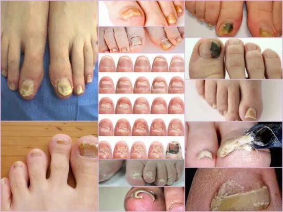 Varieties of onychomycosis