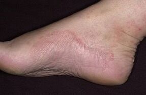 Fungal damage to the feet