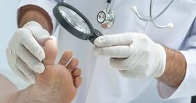 The doctor examines the feet affected by the fungus