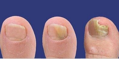 Nail fungal development stage